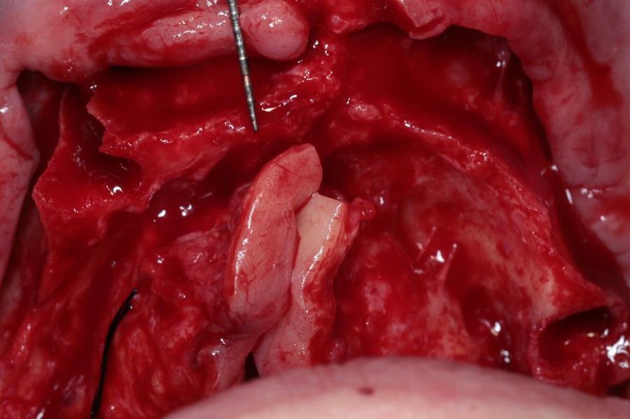 Intra-operative view
