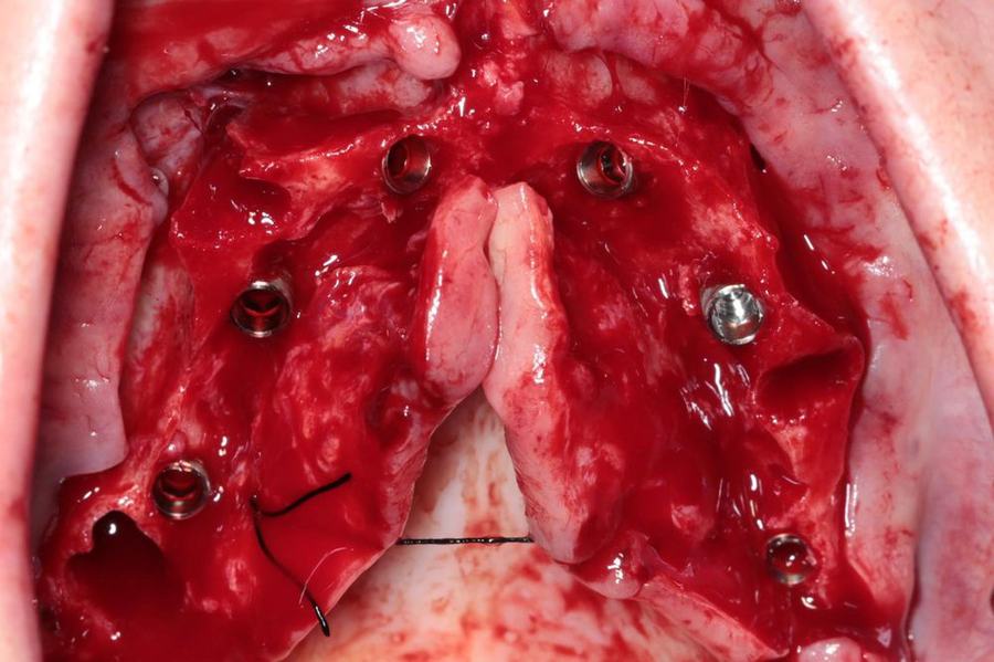 Intra-operative view