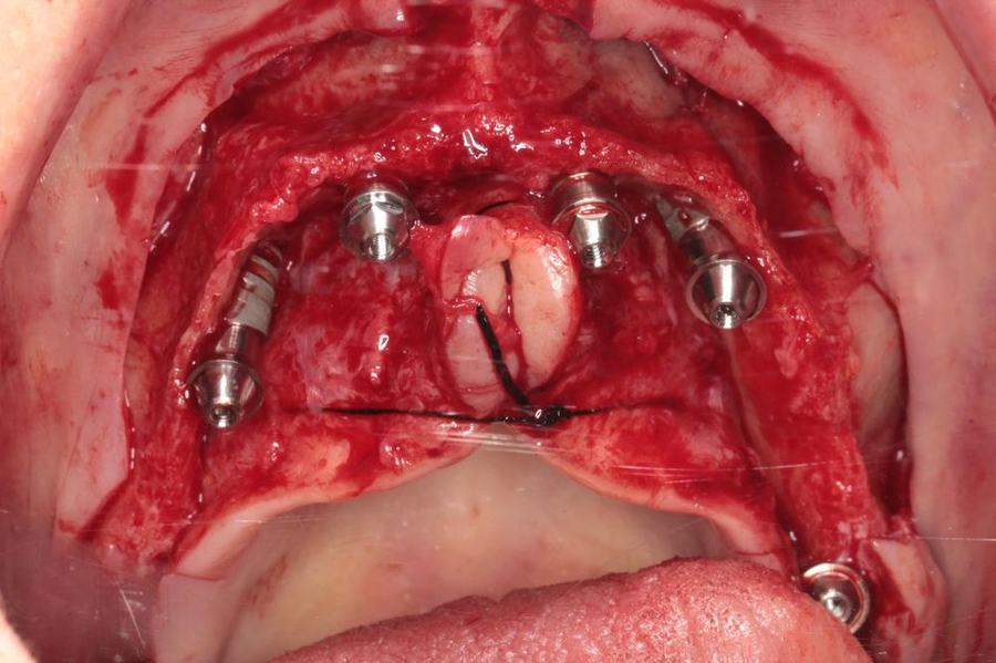 Intra-operative view