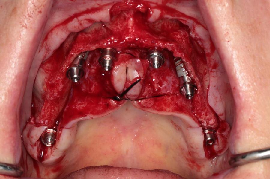 Intra-operative view