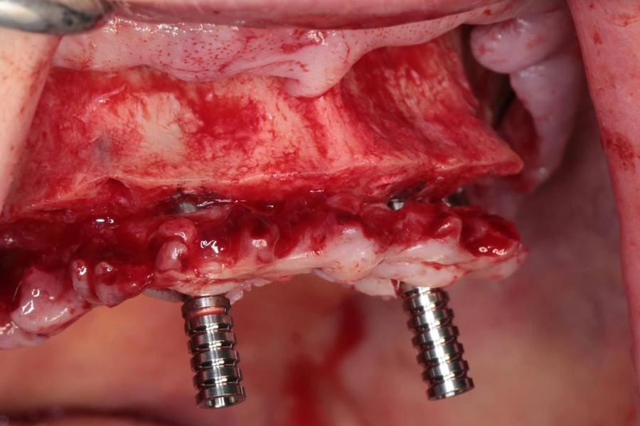 Intra-operative view