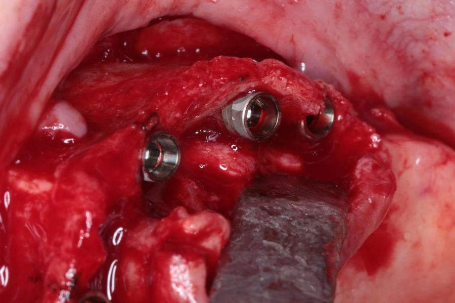 Intra-operative view