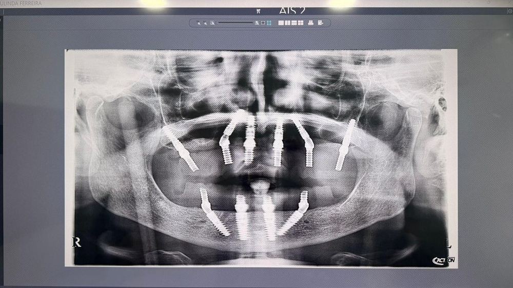 Panoramic radiograph, full-arch rehabilitation