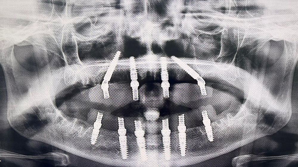 Panoramic radiograph, full-arch rehabilitation