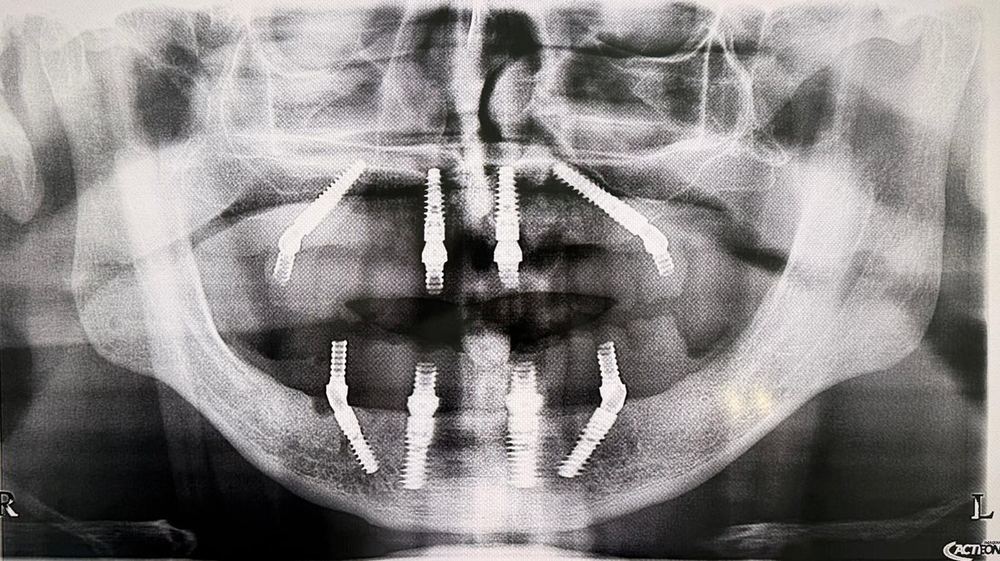 Panoramic radiograph, full-arch rehabilitation