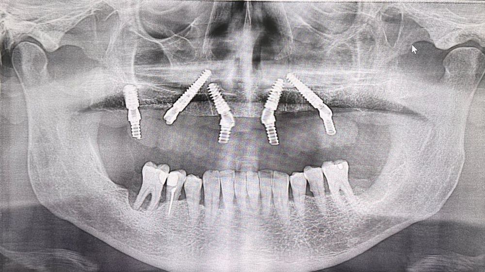 Panoramic radiograph, full-arch rehabilitation